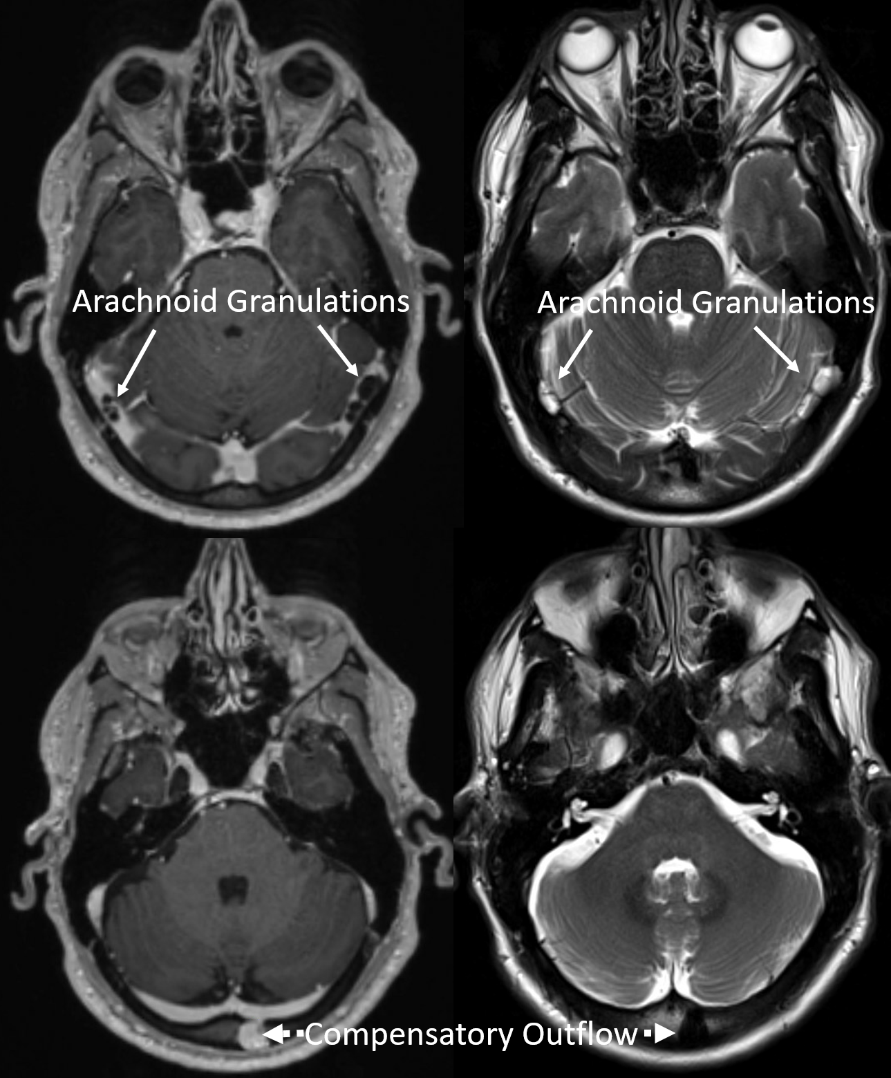 Pulsatile Tinnitus Venous Sinus Stenosis
